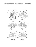 POST-OPERATIVE ADJUSTMENT TOOL, MINIMALLY INVASIVE ATTACHMENT APPARATUS,     AND ADJUSTABLE TRICUSPID RING diagram and image