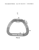 POST-OPERATIVE ADJUSTMENT TOOL, MINIMALLY INVASIVE ATTACHMENT APPARATUS,     AND ADJUSTABLE TRICUSPID RING diagram and image