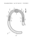 POST-OPERATIVE ADJUSTMENT TOOL, MINIMALLY INVASIVE ATTACHMENT APPARATUS,     AND ADJUSTABLE TRICUSPID RING diagram and image