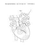 ARTIFICIAL VALVE diagram and image