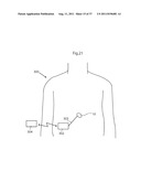 ARTIFICIAL VALVE diagram and image