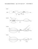 ARTIFICIAL VALVE diagram and image