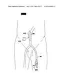 ARTIFICIAL VALVE diagram and image