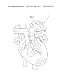 IMPROVED ARTIFICIAL VALVE diagram and image