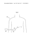 IMPROVED ARTIFICIAL VALVE diagram and image