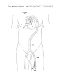 IMPROVED ARTIFICIAL VALVE diagram and image