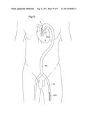 IMPROVED ARTIFICIAL VALVE diagram and image