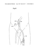 IMPROVED ARTIFICIAL VALVE diagram and image