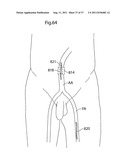 IMPROVED ARTIFICIAL VALVE diagram and image