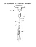 BONE PROSTHESIS diagram and image