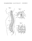 SYSTEMS AND METHODS FOR TREATING VERTEBRAL BODIES diagram and image