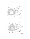 SYSTEMS AND METHODS FOR TREATING VERTEBRAL BODIES diagram and image