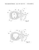 SYSTEMS AND METHODS FOR TREATING VERTEBRAL BODIES diagram and image