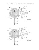 SYSTEMS AND METHODS FOR TREATING VERTEBRAL BODIES diagram and image