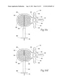 SYSTEMS AND METHODS FOR TREATING VERTEBRAL BODIES diagram and image