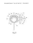 SYSTEMS AND METHODS FOR TREATING VERTEBRAL BODIES diagram and image