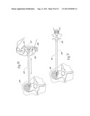 SYSTEMS AND METHODS FOR TREATING VERTEBRAL BODIES diagram and image