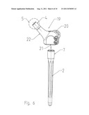 Modular Joint Prosthesis diagram and image