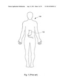 ARTIFICIAL STOMACH diagram and image