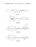 ARTIFICIAL STOMACH diagram and image