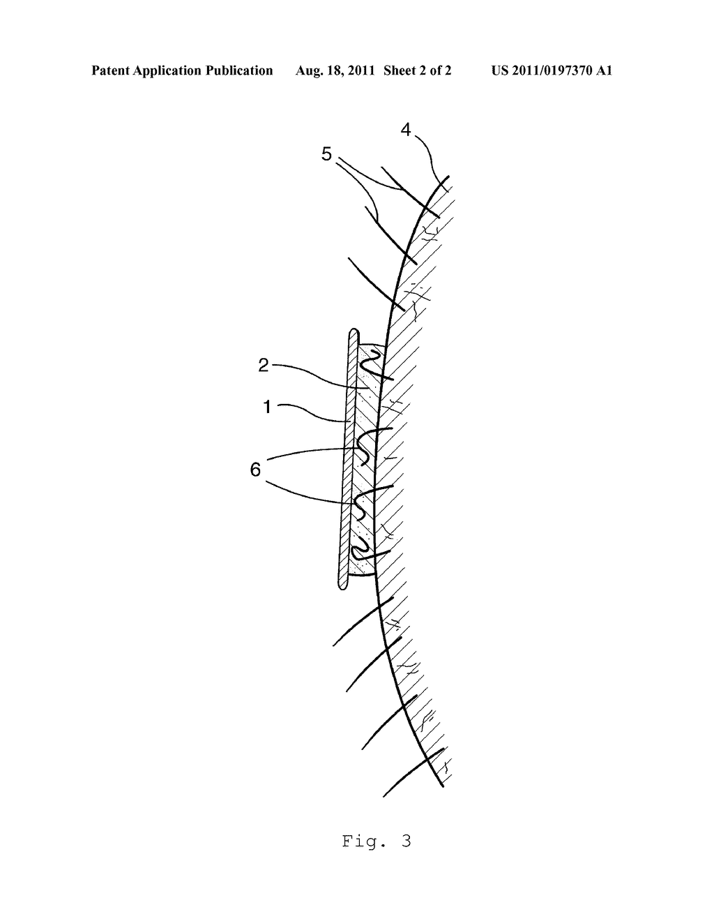 Durable Depilatory Article - diagram, schematic, and image 03