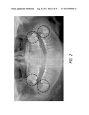 THERAPEUTIC TOOTH BUD ABLATION diagram and image