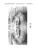 THERAPEUTIC TOOTH BUD ABLATION diagram and image