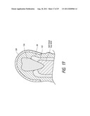 THERAPEUTIC TOOTH BUD ABLATION diagram and image