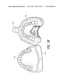 THERAPEUTIC TOOTH BUD ABLATION diagram and image