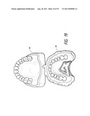 THERAPEUTIC TOOTH BUD ABLATION diagram and image