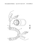 THERAPEUTIC TOOTH BUD ABLATION diagram and image