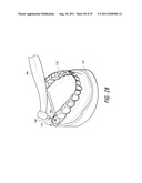 THERAPEUTIC TOOTH BUD ABLATION diagram and image