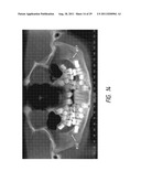 THERAPEUTIC TOOTH BUD ABLATION diagram and image