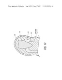 THERAPEUTIC TOOTH BUD ABLATION diagram and image