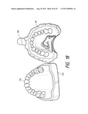 THERAPEUTIC TOOTH BUD ABLATION diagram and image