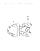 THERAPEUTIC TOOTH BUD ABLATION diagram and image