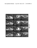 THERAPEUTIC TOOTH BUD ABLATION diagram and image