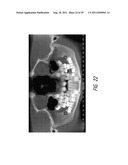 THERAPEUTIC TOOTH BUD ABLATION diagram and image