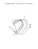 THERAPEUTIC TOOTH BUD ABLATION diagram and image