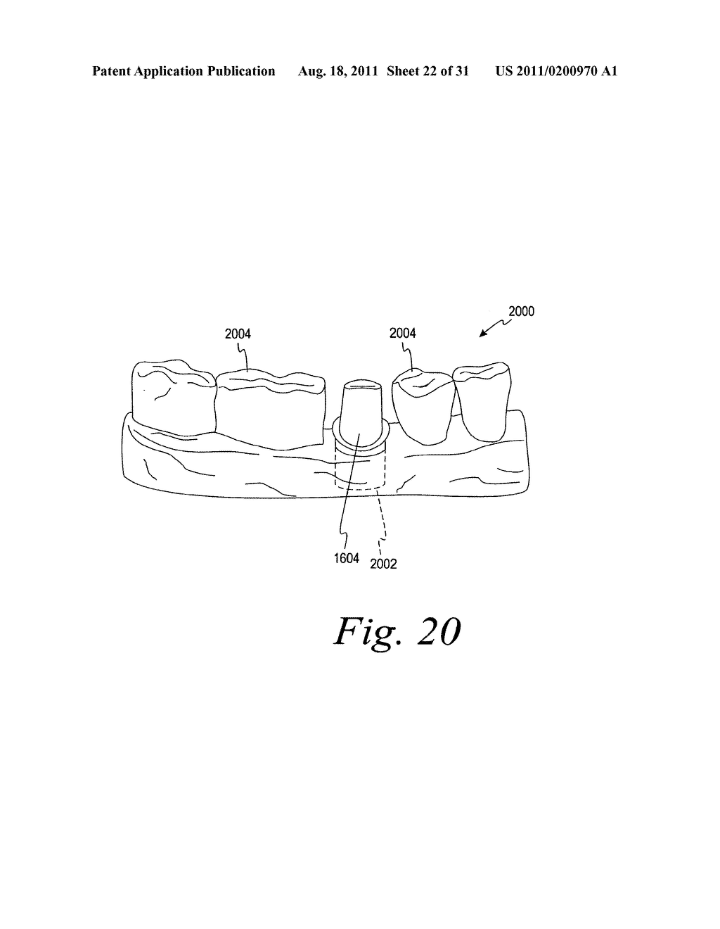 METHODS FOR PLACING AN IMPLANT ANALOG IN A PHYSICAL MODEL OF THE PATIENT'S     MOUTH - diagram, schematic, and image 23