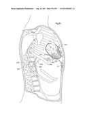 HEART HELP DEVICE, SYSTEM, AND METHOD diagram and image