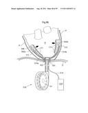 HEART HELP DEVICE, SYSTEM, AND METHOD diagram and image