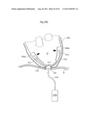 HEART HELP DEVICE, SYSTEM, AND METHOD diagram and image