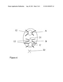 IMPLANT FOR TREATMENT OF VAGINAL AND/OR UTERINE PROLAPSE diagram and image