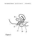 IMPLANT FOR TREATMENT OF VAGINAL AND/OR UTERINE PROLAPSE diagram and image