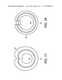 INTERLOCKING NESTED CANNULA diagram and image