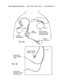 TANK FILTERS PLACED IN SERIES WITH THE LEAD WIRES OR CIRCUITS OF ACTIVE     MEDICAL DEVICES TO ENHANCE MRI COMPATIBILITY diagram and image