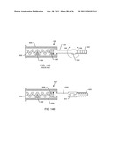 TANK FILTERS PLACED IN SERIES WITH THE LEAD WIRES OR CIRCUITS OF ACTIVE     MEDICAL DEVICES TO ENHANCE MRI COMPATIBILITY diagram and image