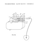 TANK FILTERS PLACED IN SERIES WITH THE LEAD WIRES OR CIRCUITS OF ACTIVE     MEDICAL DEVICES TO ENHANCE MRI COMPATIBILITY diagram and image