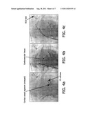 CARDIAC AND OR RESPIRATORY GATED IMAGE ACQUISITION SYSTEM AND METHOD FOR     VIRTUAL ANATOMY ENRICHED REAL TIME 2D IMAGING IN INTERVENTIONAL     RADIOFREQUENCY ABLATION OR PACE MAKER REPLACEMENT PROCECURE diagram and image